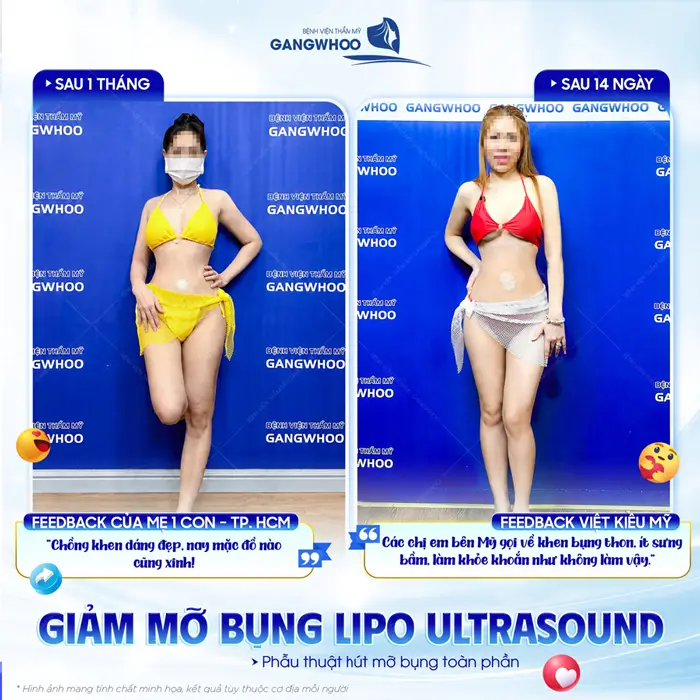 Giảm mỡ bụng công nghệ Lipo Ultrasound cải thiện diện mạo sắc vóc thon nuột diện mạo thêm cuốn hút và rạng rỡ