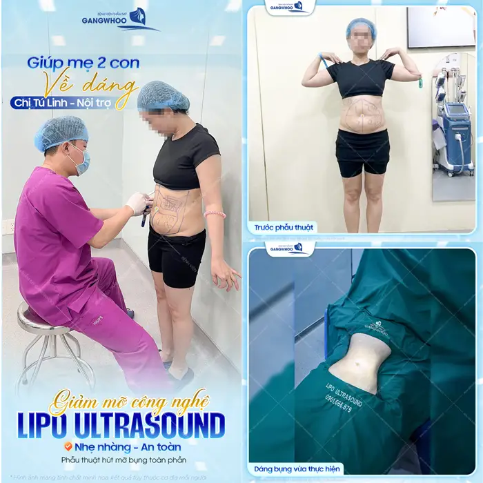 Giảm mỡ công nghệ Lipo Ultrasound giúp mẹ 2 con về dáng nhẹ nhàng, an toàn và sự thay đổi hoàn toàn khác sau phẫu thuật 