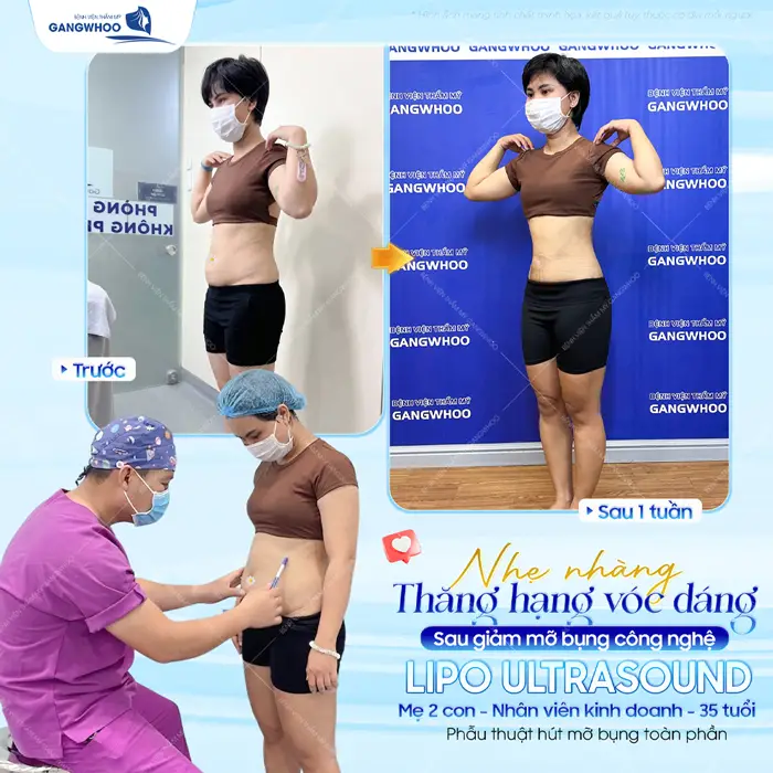 Nhẹ nhàng thăng hạng vóc dáng sau giảm mỡ ứng dụng công nghệ Lipo Ultrasound hiện đại