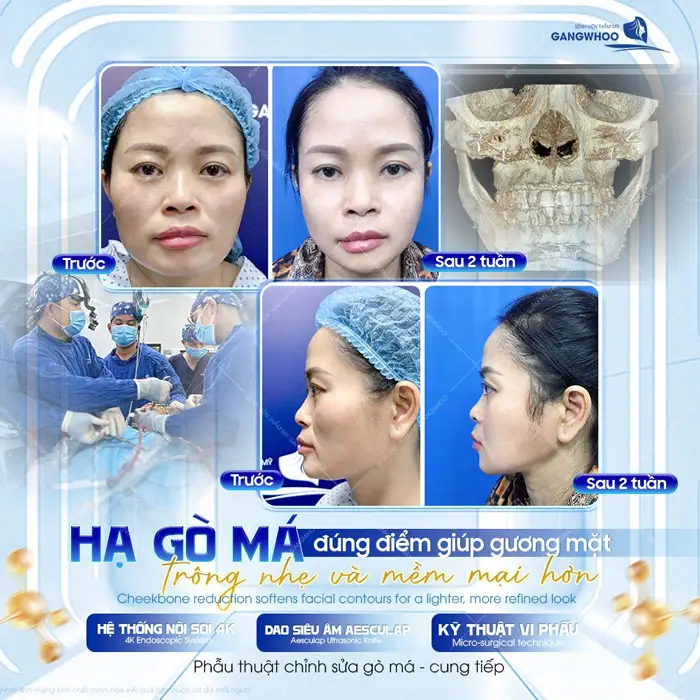 Hạ gò má đúng điểm giúp gương mặt trông nhẹ nhàng và mềm mại hơn đẹp ngay sau 2 tuần