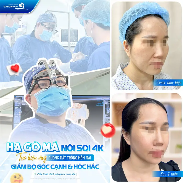 Hạ gò má nội soi 4K tạo hiệu ứng gương mặt mềm mại giảm độ góc cạnh và hốc hác hơn cho gương mặt