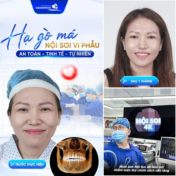 5 Biến Chứng Khi Phẫu Thuật Chỉnh Sửa Gò Má - Cung Tiếp (Hạ Gò Má) Khi Làm Đẹp Ở Địa Chỉ Không Uy Tín 4 Hạ gò má nội soi vi phẫu an toàn, tinh tế và tự nhiên sau 1 tháng diện mạo đã trẻ đẹp hơn