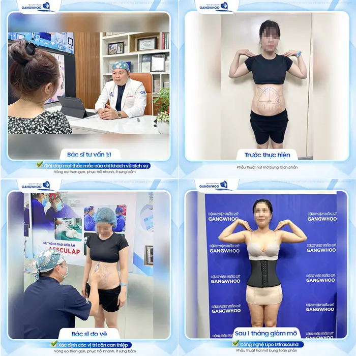 Kết quả sau 1 tháng giảm mỡ bụng công nghệ Lipo Ultrasound khách hàng đến tái khám với vòng eo con kiến thon gọn 