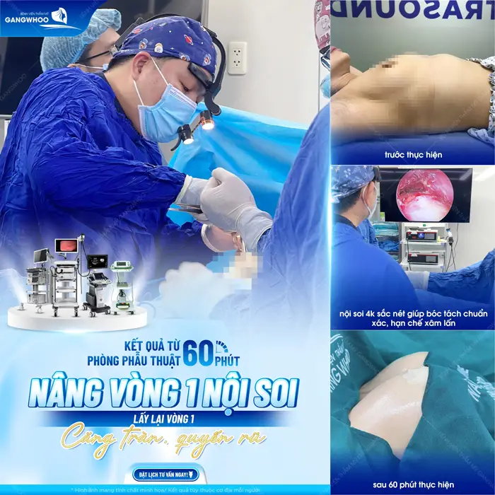 Kết quả sau 60 phút nâng vòng 1 nội soi vòng 1 căng tròn, quyến rũ