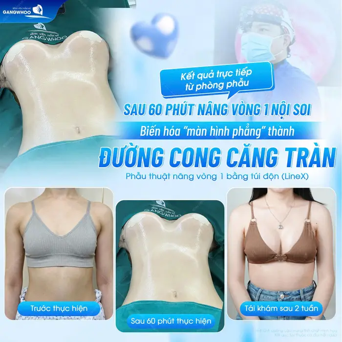 Kết quả trực tiếp từ phòng phẫu thuật sau 60 phút từ màn hình phẳng đã hóa đường cong thon nuột đầy ấn tượng