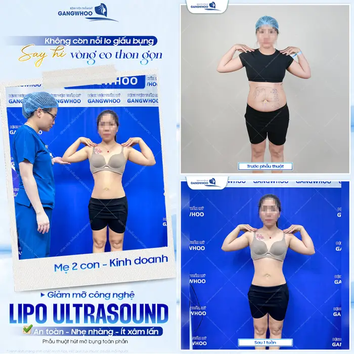 Giảm mỡ công nghệ Lipo Ultrasound say hi vòng eo thon gọn đẹp thon thả vào những ngày tái khám