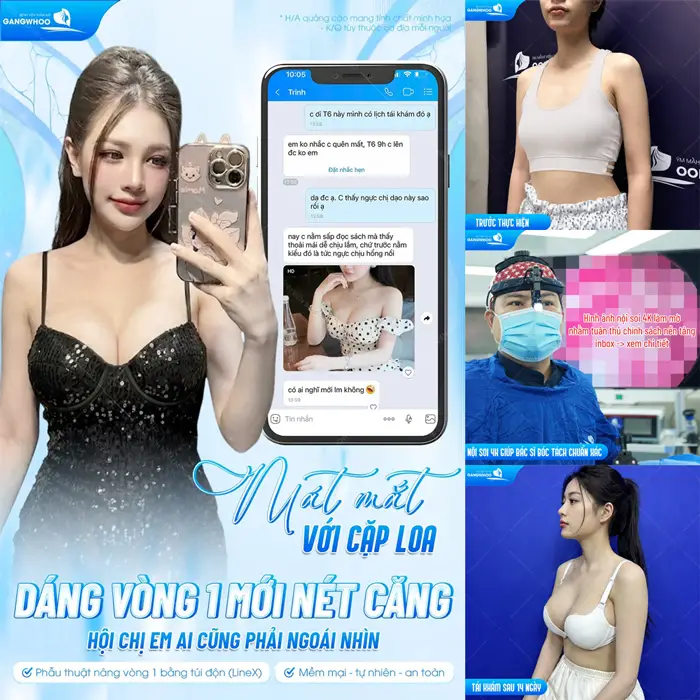 Dáng vòng 1 đẹp xuất sắc sau phẫu thuật nâng cấp vòng 1 bằng túi độn khiến hội chị em ai gặp cũng phải ngước nhìn 