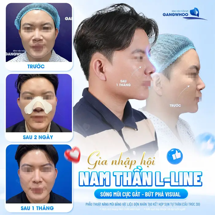 Nam thần nâng mũi L Line đẹp bứt phá visul với sắc diện đẹp chuẩn soái ca