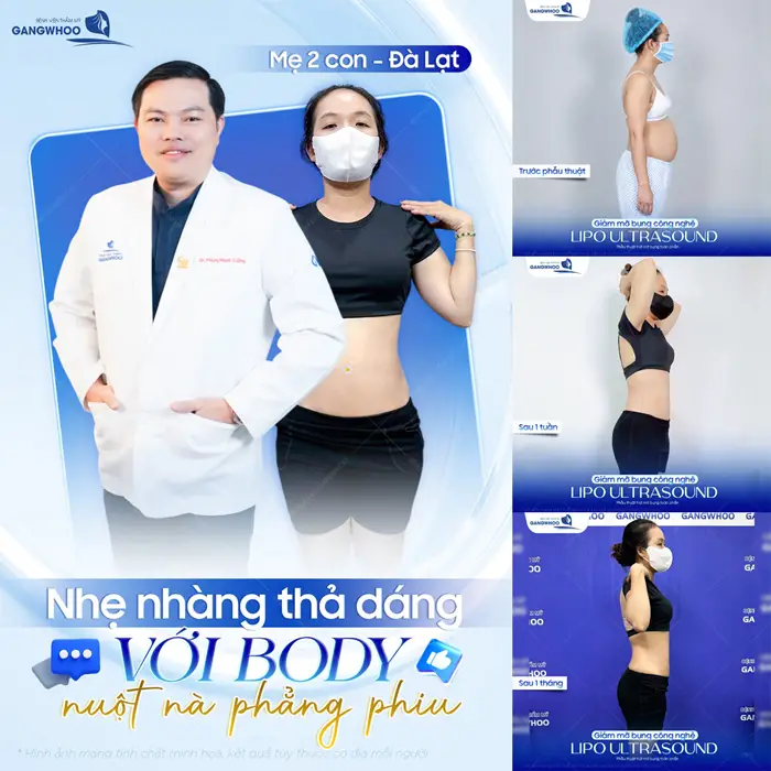 Nhẹ nhàng thả dáng khoe eo thon nuột phẳng sau phẫu thuật hút mỡ bụng toàn phần