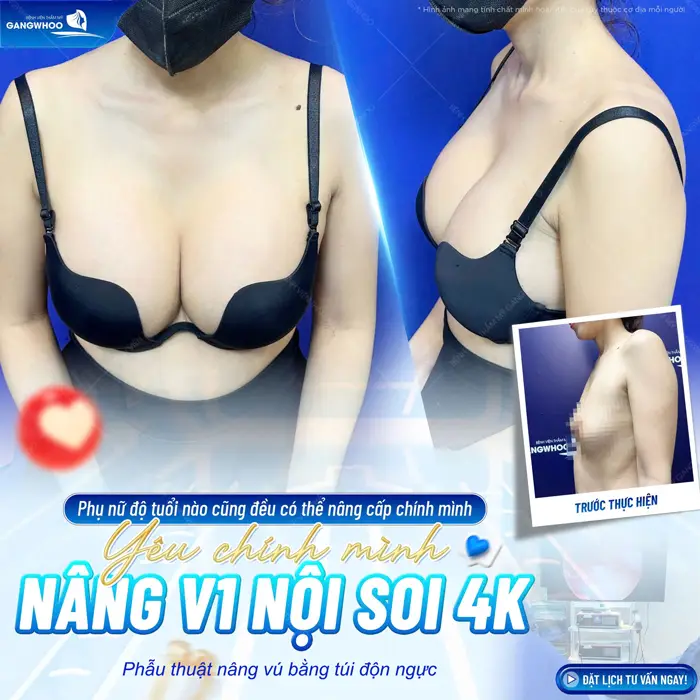 Phẫu thuật nâng vú bằng túi độn tự tin khoe đường cong quyến rũ căng đầy hấp dẫn