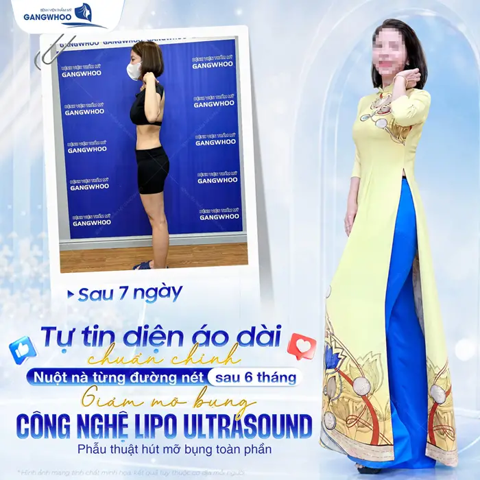 Review 14+ Địa Chỉ Hút Mỡ Bụng Ở Hà Nội Chất Lượng Cao 2 Sau 7 ngày tự tin diện áo dài chuẩn chỉnh nuột nà từng đường nét sau 6 tháng