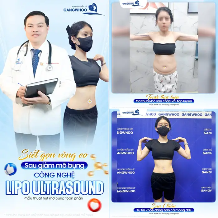 Siết gọn vòng eo sau giảm mỡ bụng công nghệ Lipo Ultrasound hiện đại 