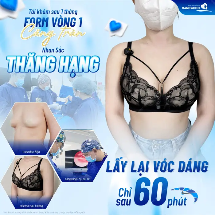Tái khám sau 1 tháng nâng vòng 1 ngực đẹp chuẩn form thăng hạng đầy cuốn hút