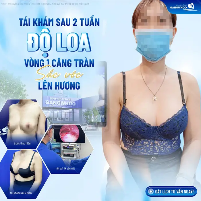 Tái khám sau 2 tuần độ loa vòng 1 căng tràn sắc vóc lên hương đầy cuốn hút