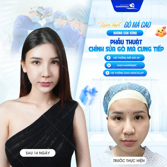 5 Biến Chứng Khi Phẫu Thuật Chỉnh Sửa Gò Má - Cung Tiếp (Hạ Gò Má) Khi Làm Đẹp Ở Địa Chỉ Không Uy Tín 8 Tạm biệt gò má cao không cân xứng phẫu thuật chỉnh sửa gò má cung tiếp với công nghệ hiện đại