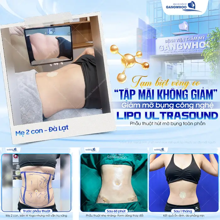 Tạm biệt vòng eo cứng đầu lâu năm mẹ 2 con đến từ Đà Lạt giảm mỡ thành công với công nghệ Lipo Ultrasound hiện đại 