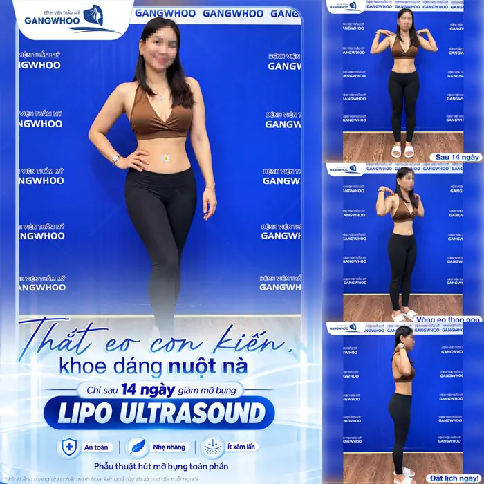 Thắt eo con kiến khoe dáng nuột nà chỉ sau 14 ngày giảm mỡ công nghệ Lipo Ultrasound