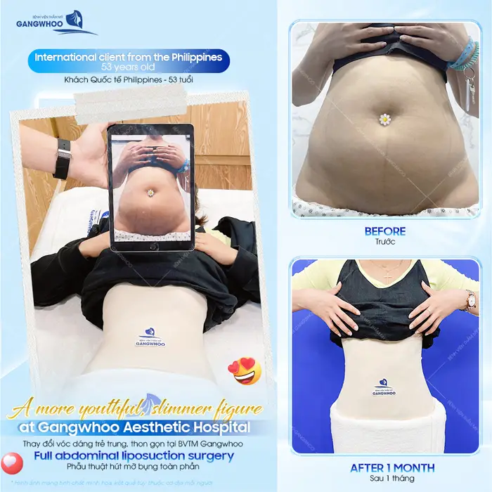 Thay đổi vóc dáng tự tin khoe eo thon bụng phẳng sau sinh tại BVTM Gangwhoo