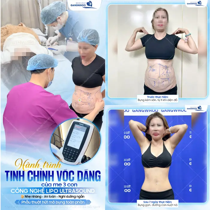 Hành trình tinh chỉnh vóc dáng của mẹ 3 con thành công mỹ mãn sau giảm mỡ bụng công nghệ Lipo Ultrasound tại BVTM Gangwhoo