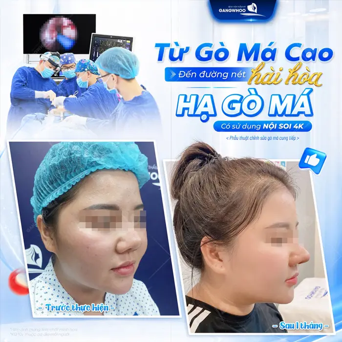 Từ gò má cao đến đường nét hài hòa hạ gò má có ứng dụng hệ thống nội soi 4K tôn lên nét đẹp cho diện mạo 