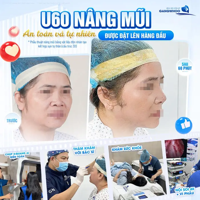U60 nâng mũi an toàn và đẹp tự nhiên tại BVTM Gangwhoo với quy trình chuẩn hóa từng bước trong phẫu thuật làm đẹp 