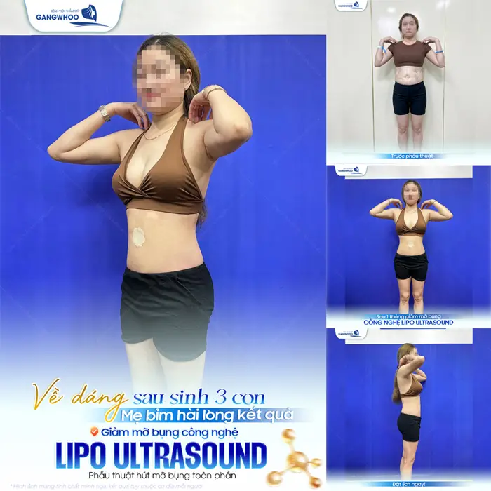 Vê dáng sau sinh 3 con mẹ bỉm hài lòng về kết quả sau phẫu thuật công nghệ Lipo Ultrasound