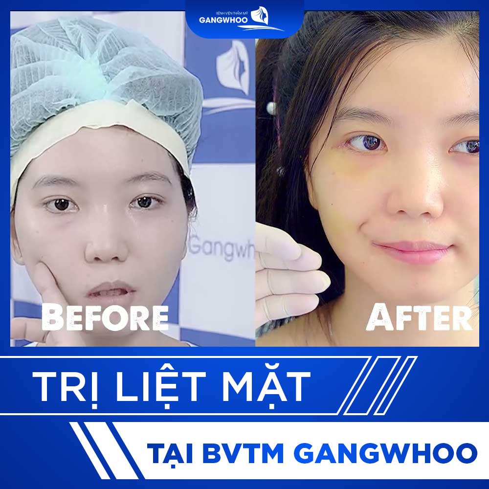 video tri liet mat 1