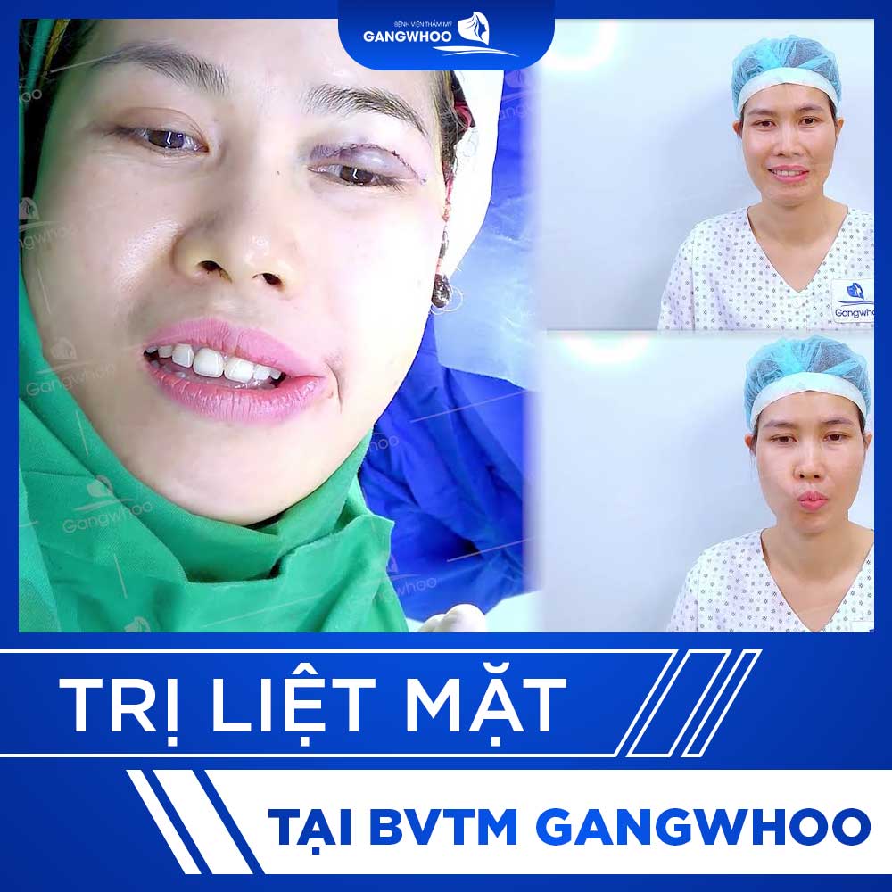 video tri liet mat 2