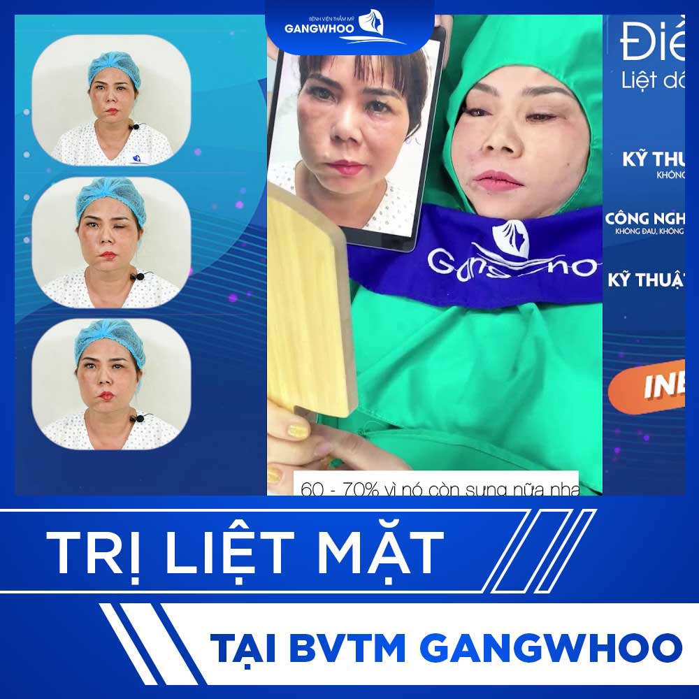 video tri liet mat 3