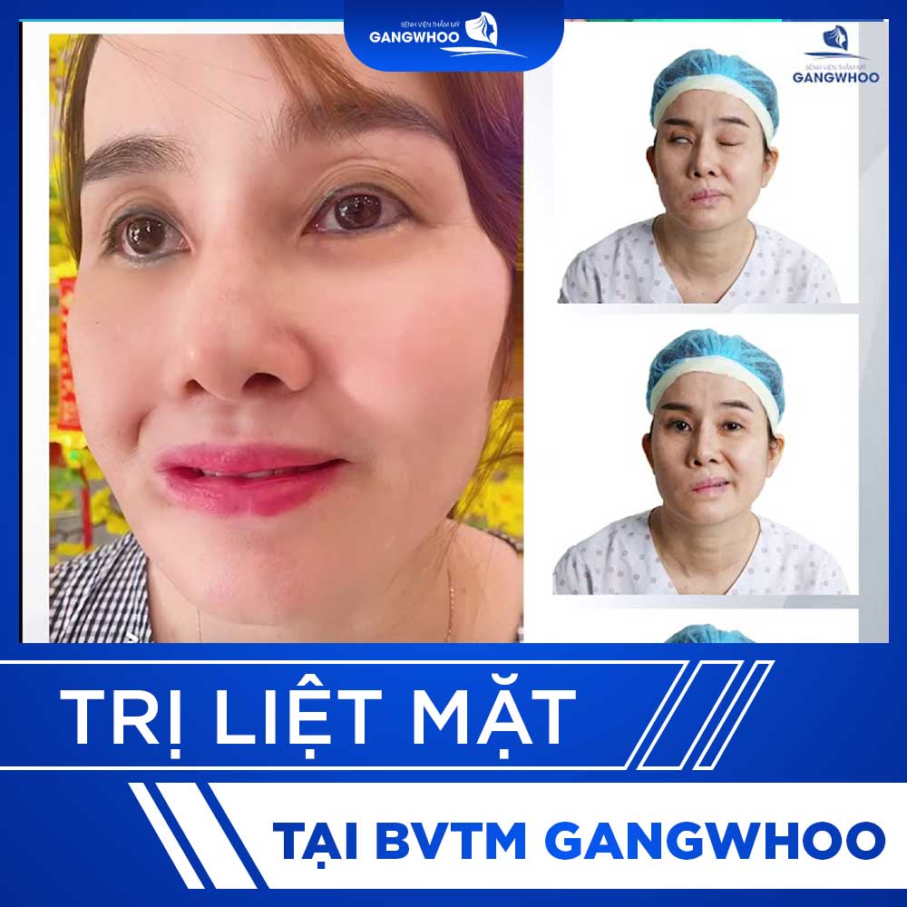 video tri liet mat 4