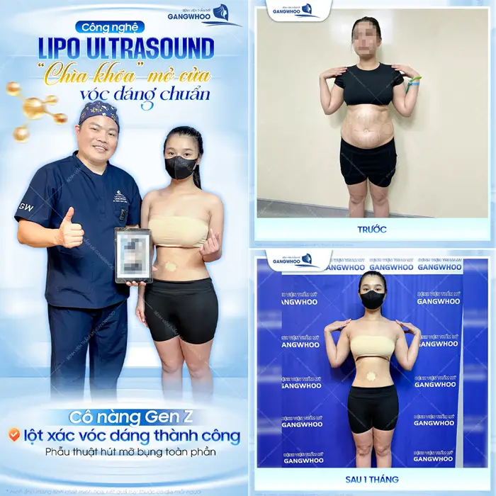 Giảm mỡ công nghệ Lipo Ultrasound vóc dáng đẹp chuẩn tự tin lột xác với hành trình tỏa sáng rạng rỡ của bản thân 