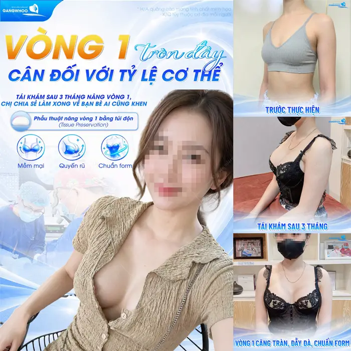 Vòng 1 tròn đầy đẹp cân đối với tỷ lệ cơ thể tái khám sau 3 tháng vóc đã đẹp đầy cuốn hút