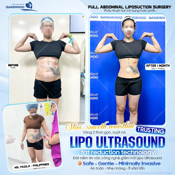 Vòng 2 đẹp gọn gàng và nuột nà là kết quả sau 1 tháng giảm mỡ bụng công nghệ Lipo Ultrasound 