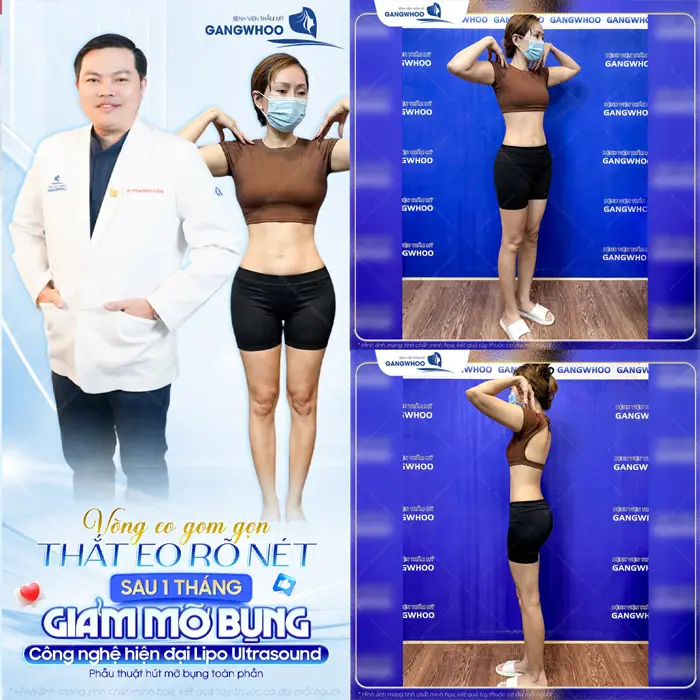 Review 14+ Địa Chỉ Hút Mỡ Bụng Ở Hà Nội Chất Lượng Cao 1 Vòng eo thon gọn thắt eo dẹp rõ sau 1 tháng giảm mỡ công nghệ Lipo Ultrasound vòng eo thon gọn và đẹp xuất sắc