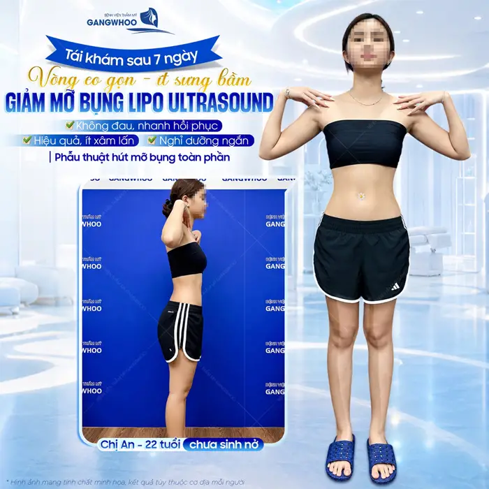 Review 14+ Địa Chỉ Hút Mỡ Bụng Ở Hà Nội Chất Lượng Cao 3 Tái khám sau 7 ngày vòng eo đẹp gọn, ít sưng bầm sau giảm mỡ công nghệ Lipo Ultrasound