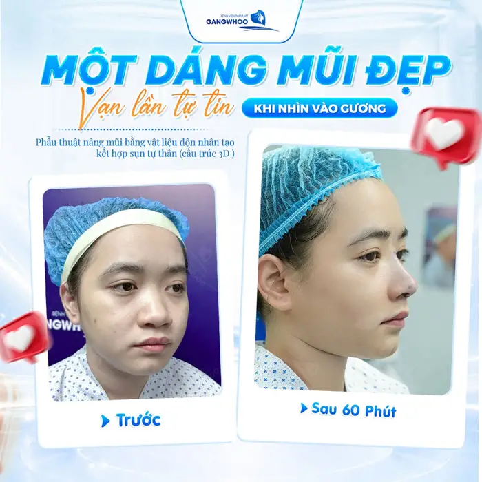 6 Cách Chăm Sóc Sau Nâng Mũi Bọc Sụn Chuẩn Y Khoa 1 1 dáng mũi đẹp vạn lần tự tin chỉ sau 60 phút từ gương mặt đến thần thái đều thăng hạng hơn thấy rõ