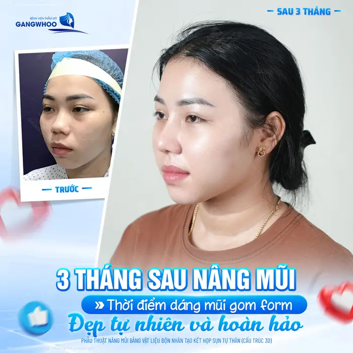 3 tháng sau nâng mũi tự tin hơn với góc nghiêng đẹp tự nhiên và hoàn hảo 