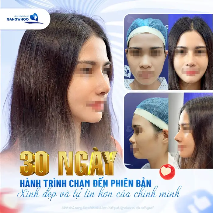 30 ngày chạm đến phiên bản xinh đẹp và tự tin hơn của chính mình chỉ với 1 ca nâng mũi