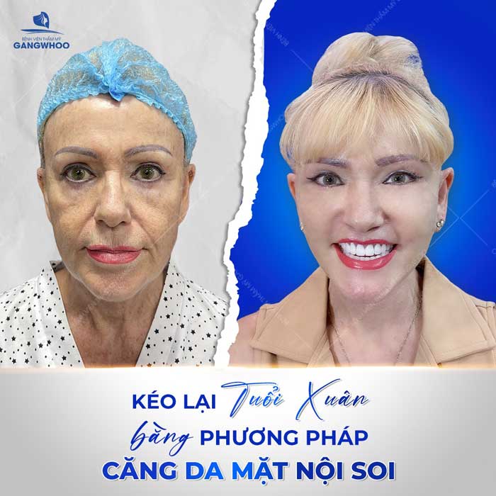 Căng Da Mặt Toàn Phần - Bí Quyết Trẻ Hóa Da Mặt Toàn Diện 41 Nhiều khách hàng quốc tế chọn Gangwhoo để thực hiện căng da mặt