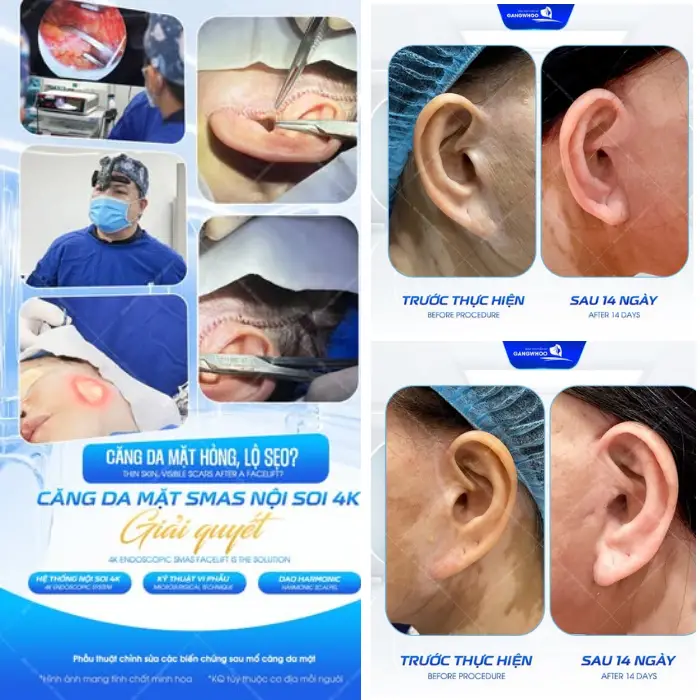 Giải pháp chỉnh sửa biến chứng căng da mặt bằng công nghệ Smas nội soi 4K hiện đại