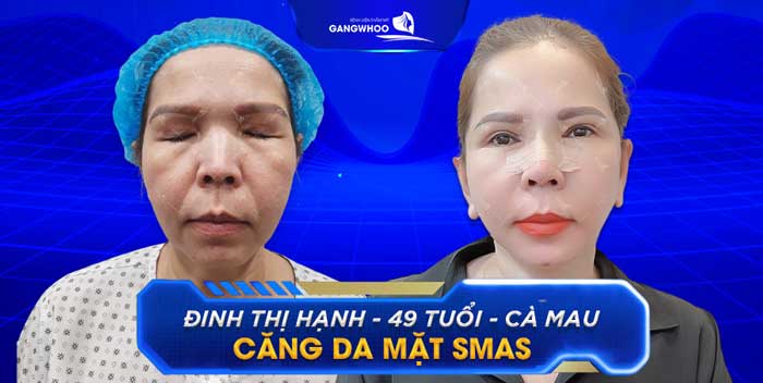 Căng da mặt Smas tại Gangwhoo không để lại sẹo