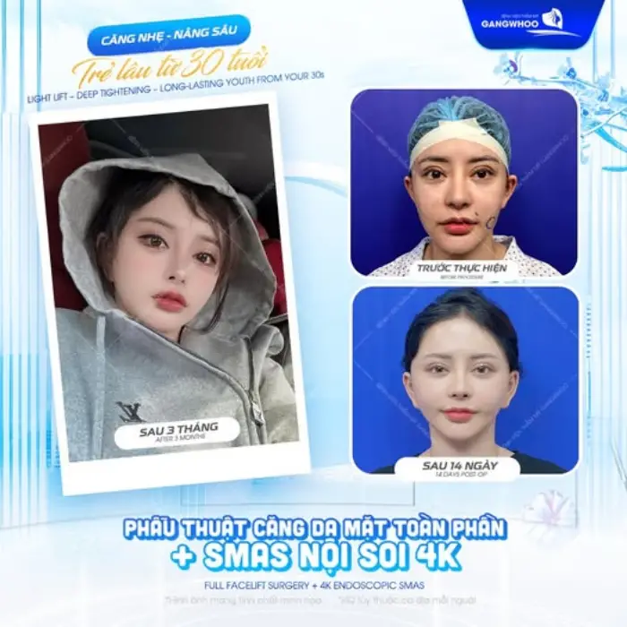 Trẻ hóa da mặt toàn diện với công nghệ căng da SMAS nội soi 4K tại Bệnh viện thẩm mỹ Gangwhoo