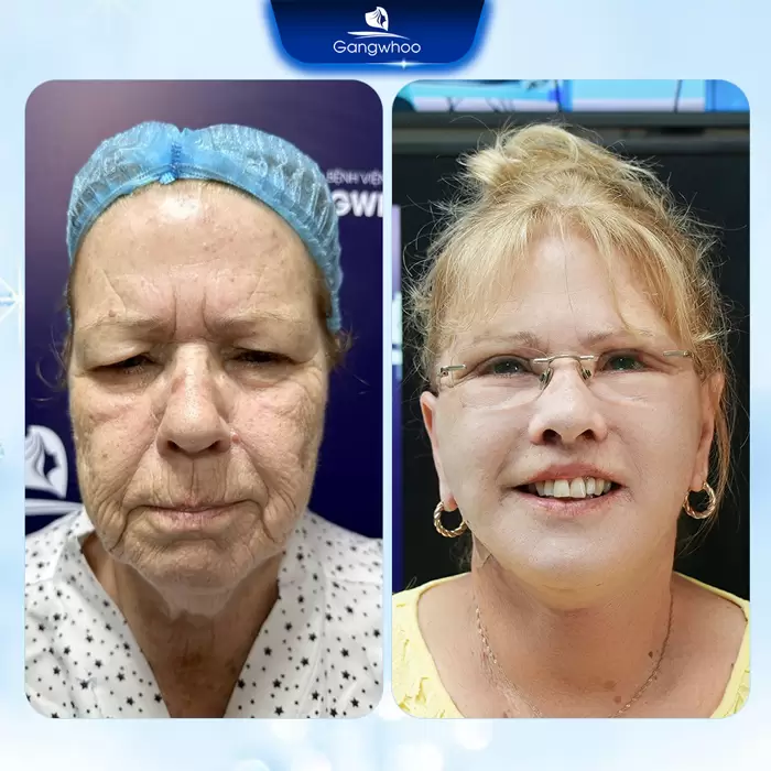 cat da thua vung mat en 1