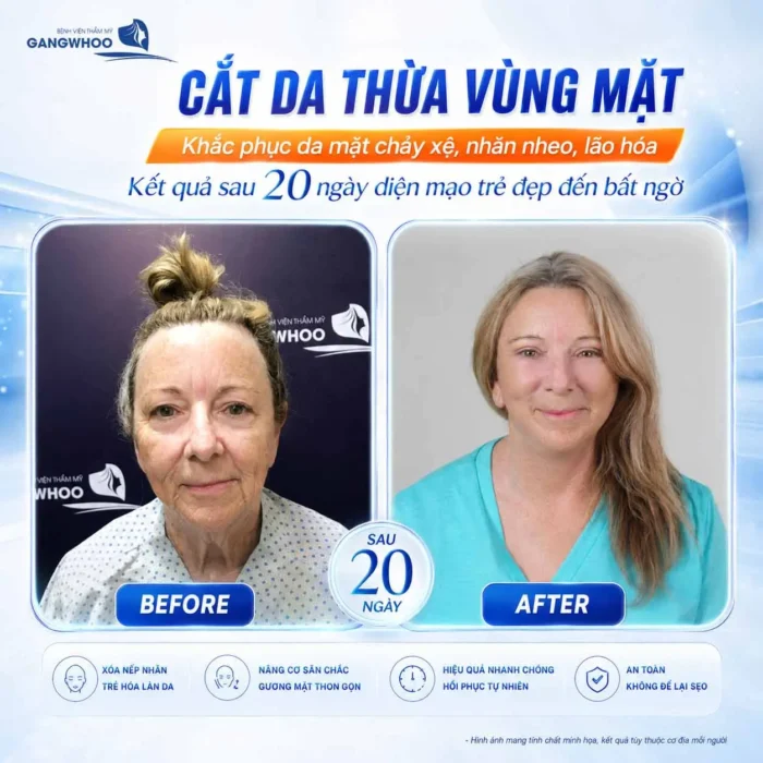 Cắt Da Thừa Vùng Mặt "Hồi Xuân" Ngay Lớp Da Lão Hóa 2 Cắt Da Thừa Vùng Mặt "Hồi Xuân" Ngay Lớp Da Lão Hóa