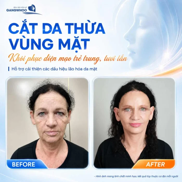Cắt Da Thừa Vùng Mặt "Hồi Xuân" Ngay Lớp Da Lão Hóa 3 Cắt Da Thừa Vùng Mặt "Hồi Xuân" Ngay Lớp Da Lão Hóa