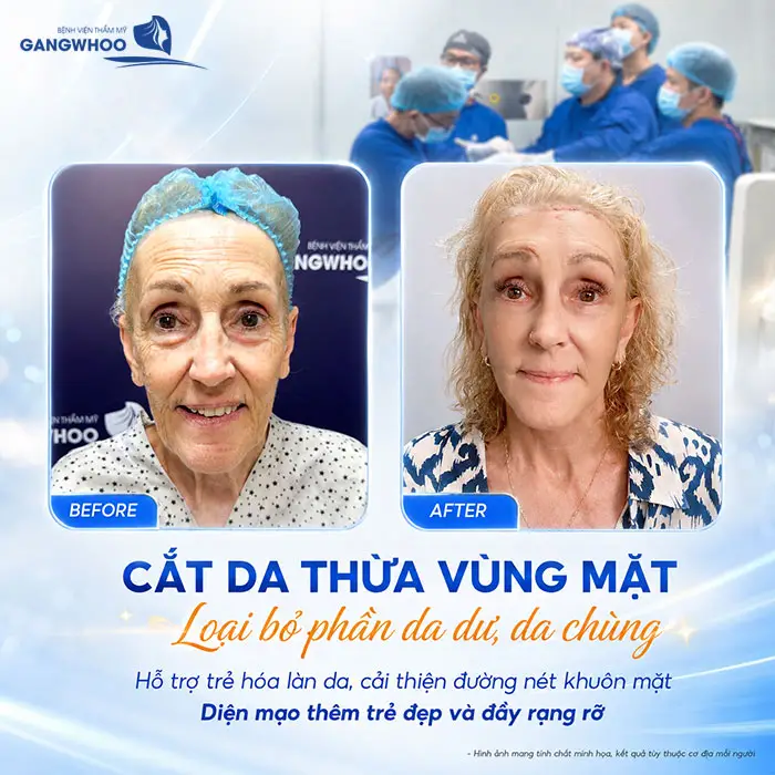 Cắt Da Thừa Vùng Mặt "Hồi Xuân" Ngay Lớp Da Lão Hóa 4 Cắt Da Thừa Vùng Mặt "Hồi Xuân" Ngay Lớp Da Lão Hóa