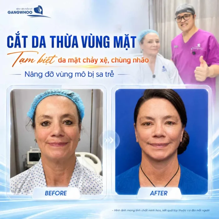 Cắt Da Thừa Vùng Mặt "Hồi Xuân" Ngay Lớp Da Lão Hóa 7 Cắt Da Thừa Vùng Mặt "Hồi Xuân" Ngay Lớp Da Lão Hóa