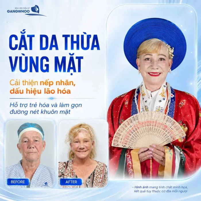 Cắt Da Thừa Vùng Mặt "Hồi Xuân" Ngay Lớp Da Lão Hóa 20 cat da thua vung mat vn 6 e1785293955921