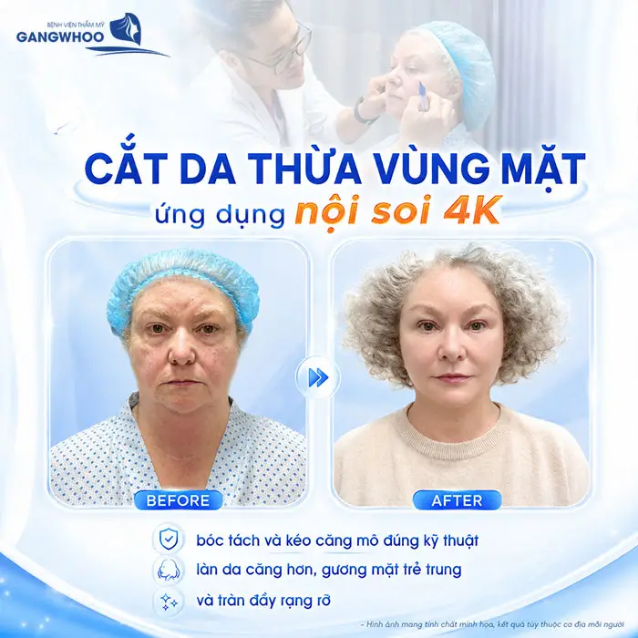 Cắt Da Thừa Vùng Mặt "Hồi Xuân" Ngay Lớp Da Lão Hóa 1 Cắt Da Thừa Vùng Mặt "Hồi Xuân" Ngay Lớp Da Lão Hóa