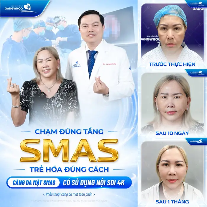 Chạm đúng tầng Smas trẻ hóa đúng cách sau căng da mặt màn lột xác đầy bất ngờ sau 1 tháng trẻ hóa khuôn mặt